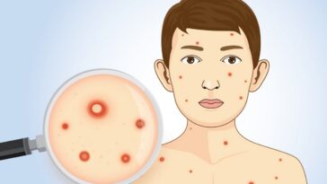 ανεμοβλογια