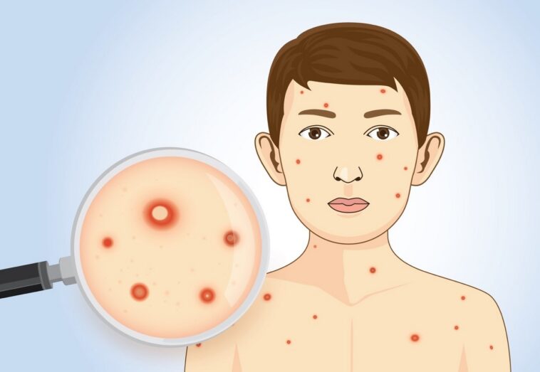 ανεμοβλογια