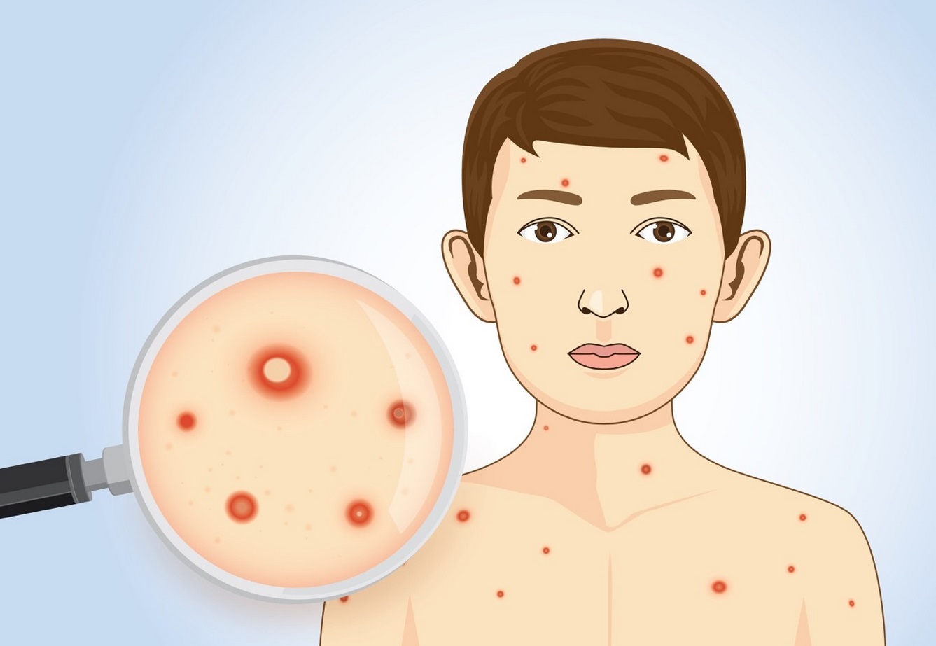 ανεμοβλογια