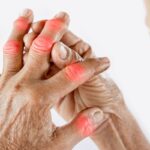 Ρευματοειδής αρθρίτιδα