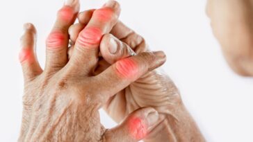 Ρευματοειδής αρθρίτιδα