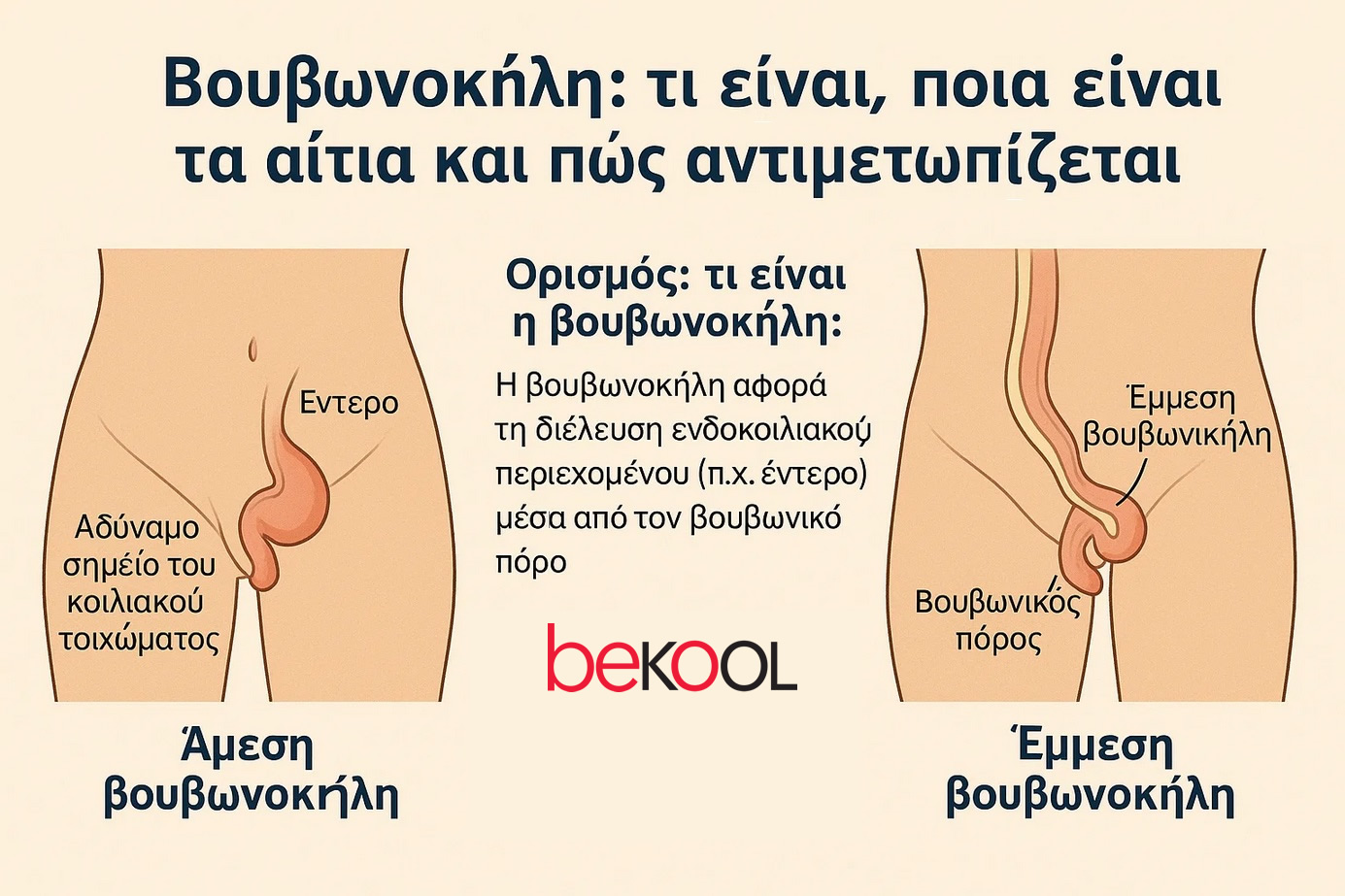 βουβονοκήλη