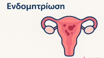 Τι είναι η ενδομητρίωση