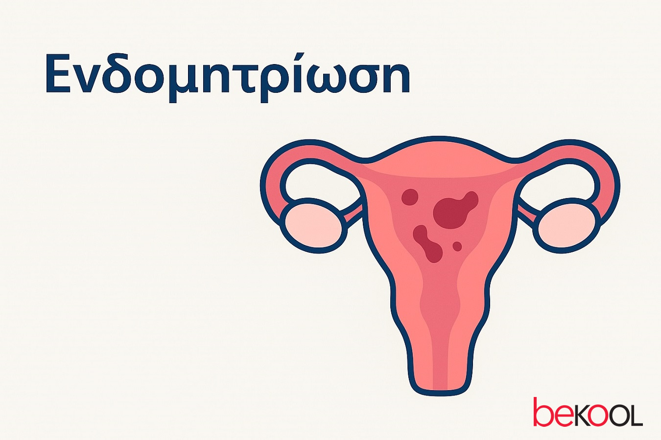 Τι είναι η ενδομητρίωση