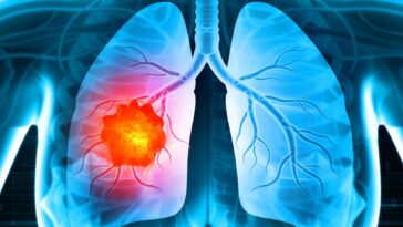 Καρκίνος του πνεύμονα