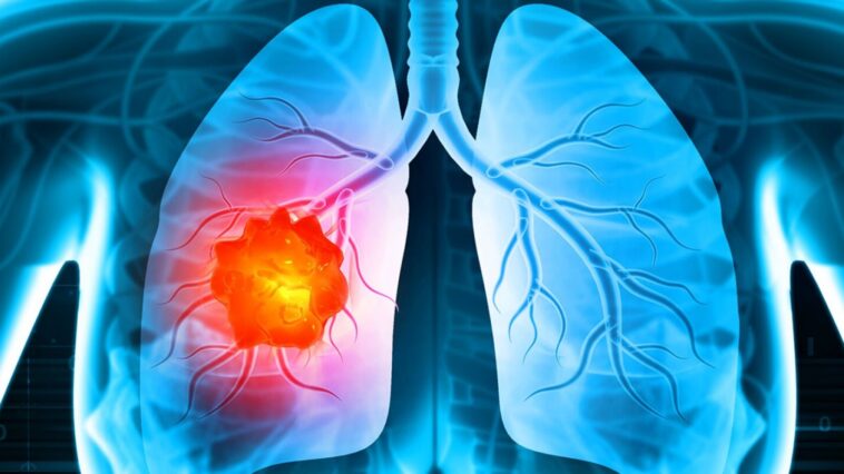 Καρκίνος του πνεύμονα