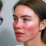 Συστηματικός Ερυθηματώδης Λύκος: Πώς επηρεάζει το σώμα και τι να κάνετε