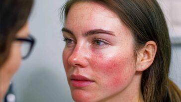 Συστηματικός Ερυθηματώδης Λύκος: Πώς επηρεάζει το σώμα και τι να κάνετε