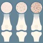 Οστεοπόρωση