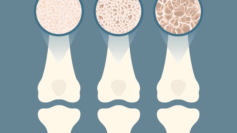 Οστεοπόρωση