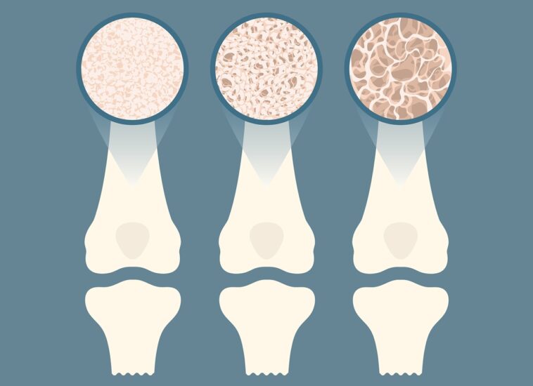 Οστεοπόρωση
