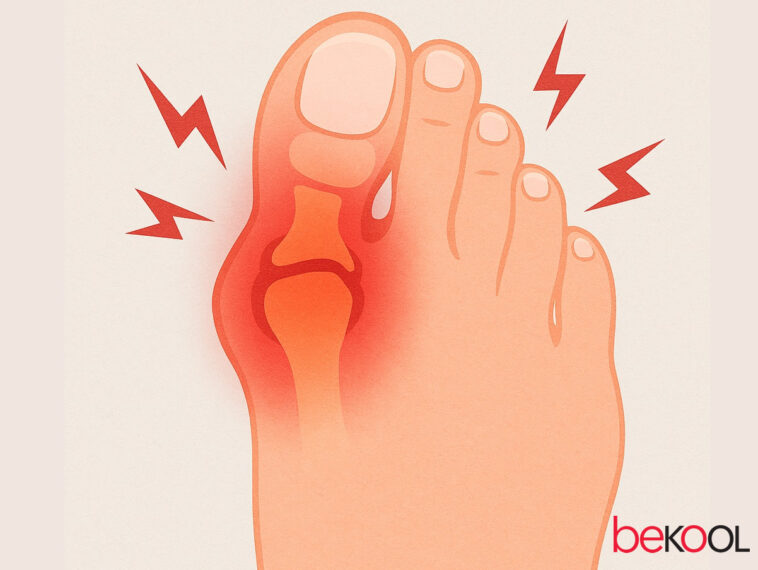 Ουρική αρθρίτιδα: Διατροφή και θεραπείες για το υψηλό ουρικό οξύ