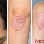 Ψωρίαση: Συμπτώματα στο δέρμα και σύγχρονες θεραπείες