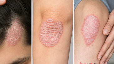 Ψωρίαση: Συμπτώματα στο δέρμα και σύγχρονες θεραπείες