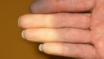 Σύνδρομο Ρεϊνό