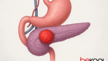 Καρκίνος του παγκρέατος