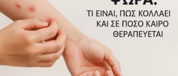 Σε ποσο καιρο θεραπευεται η ψωρα