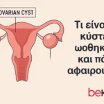 Κύστεις ωοθηκών
