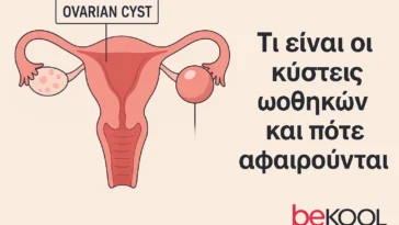 Κύστεις ωοθηκών