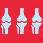 Οστεοαρθρίτιδα