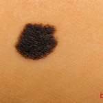 Το σημάδι στο δέρμα σου που μπορεί να είναι το πρώτο του μελανώματος