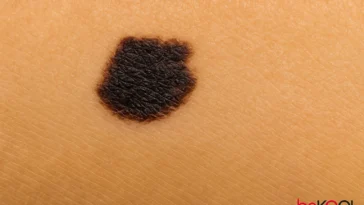 Το σημάδι στο δέρμα σου που μπορεί να είναι το πρώτο του μελανώματος