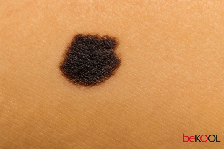 Το σημάδι στο δέρμα σου που μπορεί να είναι το πρώτο του μελανώματος