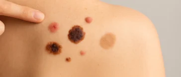 σημάδια στο δέρμα που πρέπει να ελέγξει άμεσα ο δερματολόγος