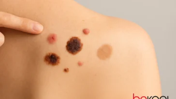 σημάδια στο δέρμα που πρέπει να ελέγξει άμεσα ο δερματολόγος