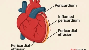 τι είναι η περικαρδίτιδα